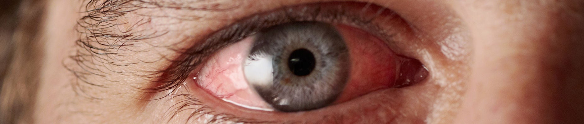 Closeup of irritated red bloodshot eye