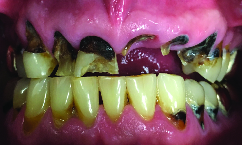 Meth Mouth example